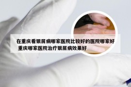 在重庆看银屑病哪家医院比较好的医院哪家好 重庆哪家医院治疗银屑病效果好