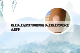 脸上头上起皮好像银屑病 头上脸上皮屑多怎么回事