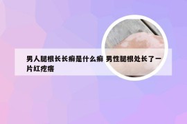 男人腿根长长癣是什么癣 男性腿根处长了一片红疙瘩