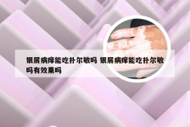 银屑病痒能吃扑尔敏吗 银屑病痒能吃扑尔敏吗有效果吗