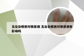 五谷杂粮粥对银屑病 五谷杂粮粥对银屑病有影响吗