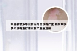 银屑病很多年没有治疗也没有严重 银屑病很多年没有治疗也没有严重后遗症