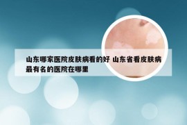 山东哪家医院皮肤病看的好 山东省看皮肤病最有名的医院在哪里