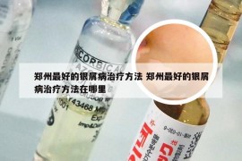 郑州最好的银屑病治疗方法 郑州最好的银屑病治疗方法在哪里