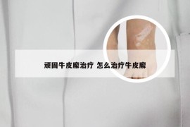 顽固牛皮廨治疗 怎么治疗牛皮廨