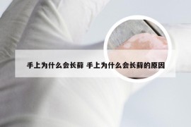 手上为什么会长藓 手上为什么会长藓的原因
