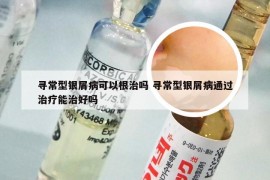 寻常型银屑病可以根治吗 寻常型银屑病通过治疗能治好吗