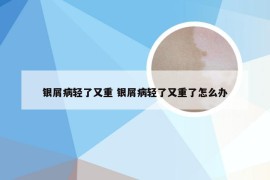 银屑病轻了又重 银屑病轻了又重了怎么办