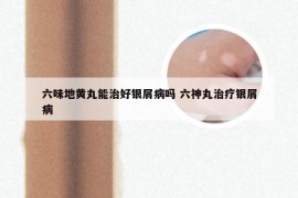 六味地黄丸能治好银屑病吗 六神丸治疗银屑病