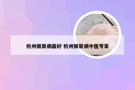 杭州银屑病最好 杭州银屑病中医专家