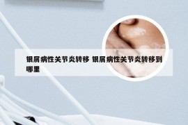 银屑病性关节炎转移 银屑病性关节炎转移到哪里