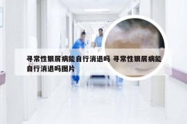 寻常性银屑病能自行消退吗 寻常性银屑病能自行消退吗图片