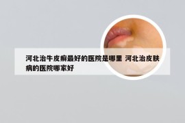 河北治牛皮癣最好的医院是哪里 河北治皮肤病的医院哪家好