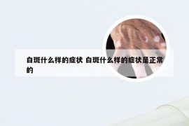 白斑什么样的症状 白斑什么样的症状是正常的
