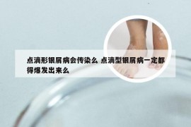 点滴形银屑病会传染么 点滴型银屑病一定都得爆发出来么