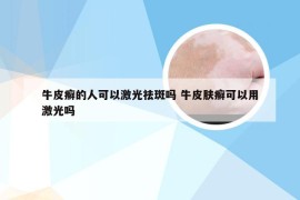 牛皮癣的人可以激光祛斑吗 牛皮肤癣可以用激光吗