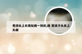 男孩头上长类似癣一样的,痒 男孩子头皮上头癣