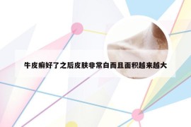 牛皮癣好了之后皮肤非常白而且面积越来越大