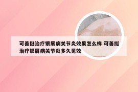 可善挺治疗银屑病关节炎效果怎么样 可善挺治疗银屑病关节炎多久见效