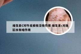 维生素C对牛皮癣有没有作用 维生素c对鱼缸水有啥作用