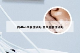 白dlan风疯传染吗 白风癫会传染吗