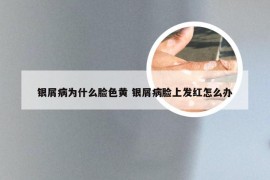 银屑病为什么脸色黄 银屑病脸上发红怎么办