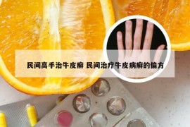 民间高手治牛皮癣 民间治疗牛皮病癣的偏方