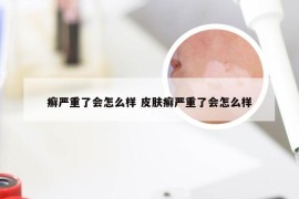 癣严重了会怎么样 皮肤癣严重了会怎么样