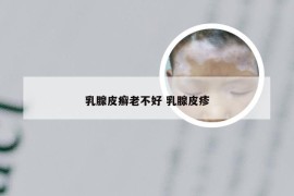 乳腺皮癣老不好 乳腺皮疹