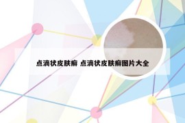 点滴状皮肤癣 点滴状皮肤癣图片大全