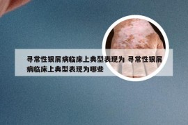 寻常性银屑病临床上典型表现为 寻常性银屑病临床上典型表现为哪些