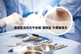 蒲地蓝消炎片牛皮癣 蒲地蓝 牛黄解毒片