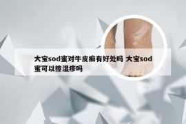 大宝sod蜜对牛皮癣有好处吗 大宝sod蜜可以擦湿疹吗