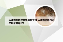 天津哪家医院是银屑病专科 天津哪家医院治疗银屑病最好?