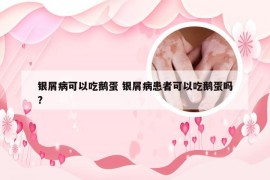 银屑病可以吃鹅蛋 银屑病患者可以吃鹅蛋吗?