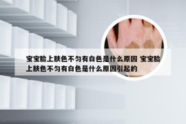 宝宝脸上肤色不匀有白色是什么原因 宝宝脸上肤色不匀有白色是什么原因引起的