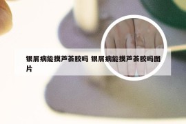 银屑病能摸芦荟胶吗 银屑病能摸芦荟胶吗图片
