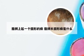 胳膊上起一个圆形的癣 胳膊长圆形癣是什么