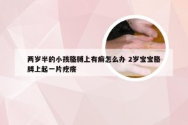 两岁半的小孩胳膊上有癣怎么办 2岁宝宝胳膊上起一片疙瘩
