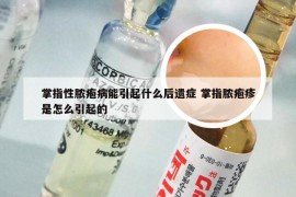 掌指性脓疱病能引起什么后遗症 掌指脓疱疹是怎么引起的