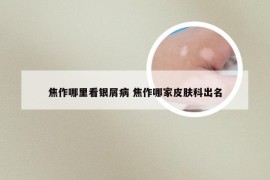 焦作哪里看银屑病 焦作哪家皮肤科出名