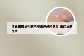 宿迁银屑病科医院哪家好就问楚街 宿迁皮肤医院