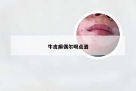 牛皮癣偶尔喝点酒