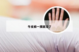 牛皮癣一摸就没了