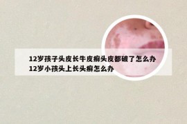 12岁孩子头皮长牛皮癣头皮都破了怎么办 12岁小孩头上长头癣怎么办