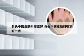 包头中医皮肤科哪家好 包头中医皮肤科哪家好一点