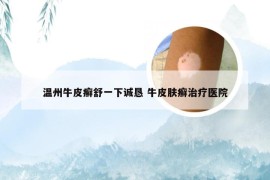温州牛皮癣舒一下诚恳 牛皮肤癣治疗医院