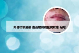 南昌祛银屑病 南昌银屑病医院肤康 贴吧