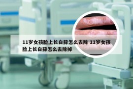 11岁女孩脸上长白藓怎么去除 11岁女孩脸上长白藓怎么去除掉