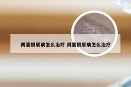 阴囊银屑病怎么治疗 阴囊银屑病怎么治疗